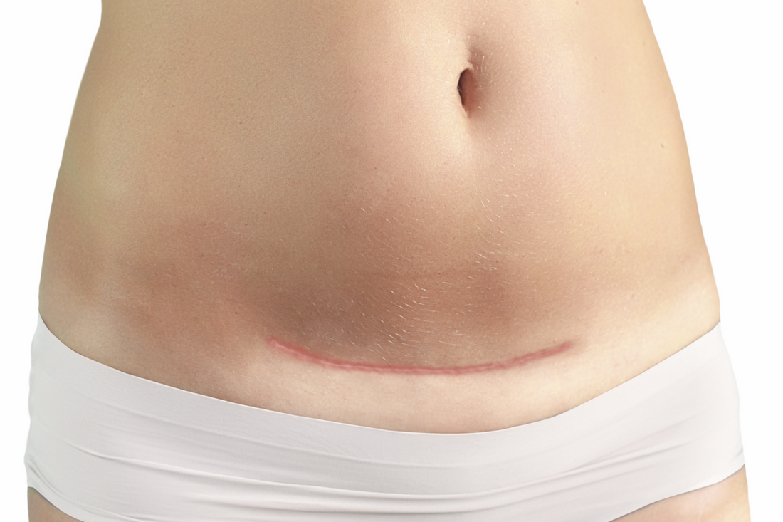 Wie kann ich meine Kaiserschnittnarbe am besten pflegen?