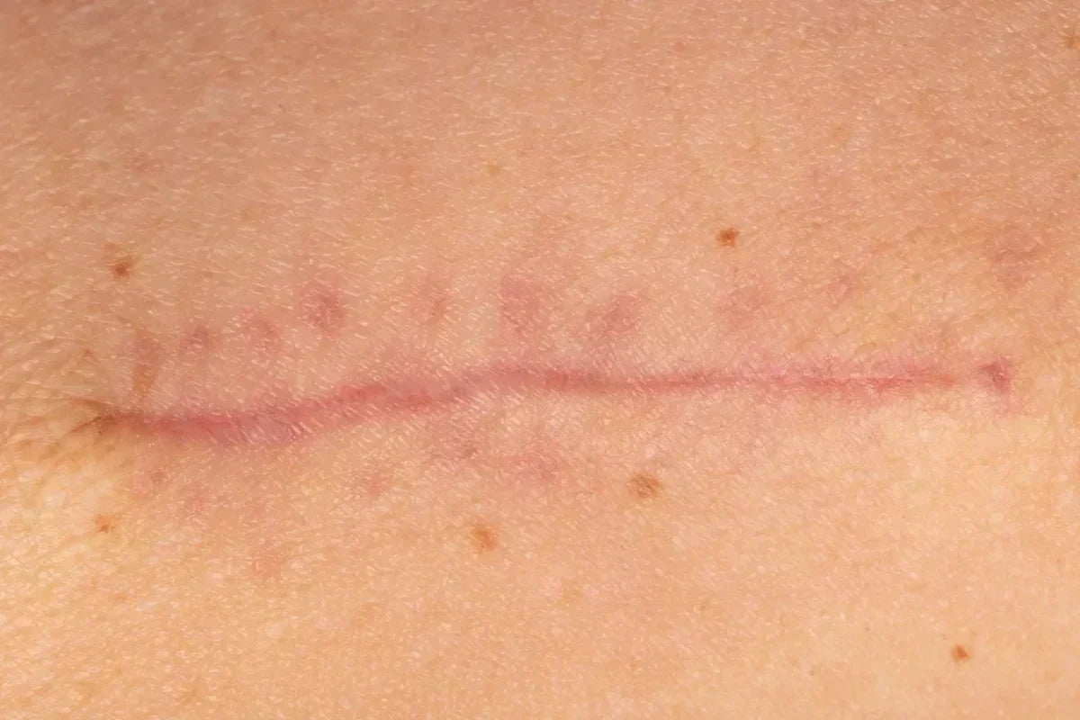 The Dermatologist’s Guide to Scar Healing: Fastes…