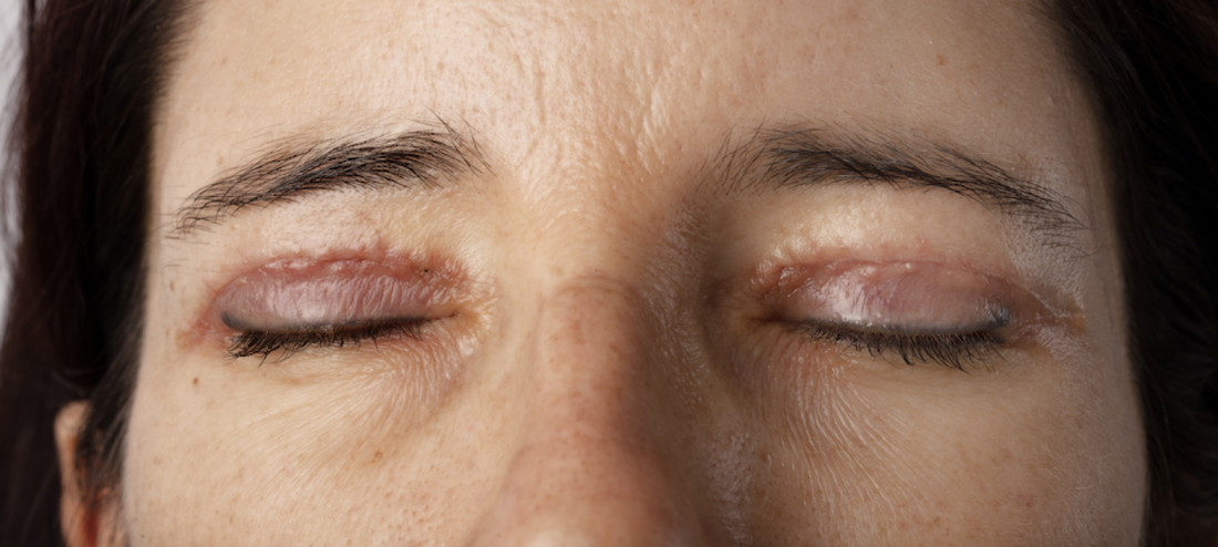 Eyelid Lift and Scar Care: A Fresh Look at a New Life